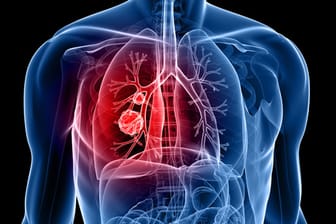 Lungenkrebs bleibt häufig zu lange unerkannt.