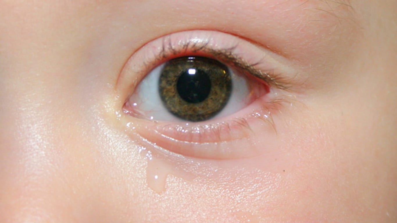 Hinter tränenden Augen bei Kindern steckt nicht immer ein Fremdkörper.