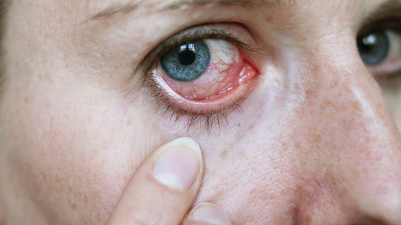 Uveitis: Rote Augen weisen auf eine Entzündung der Gefäßhaut hin.