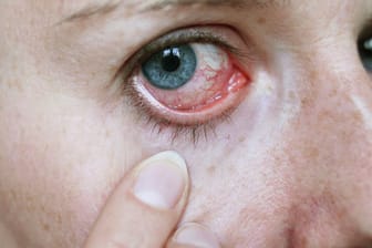 Uveitis: Rote Augen weisen auf eine Entzündung der Gefäßhaut hin.