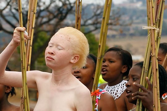 Nicht überall werden Albinos gejagt: Ein Albino-Mädchen nimmt an einem rituellen Tanz in Swasiland teil.