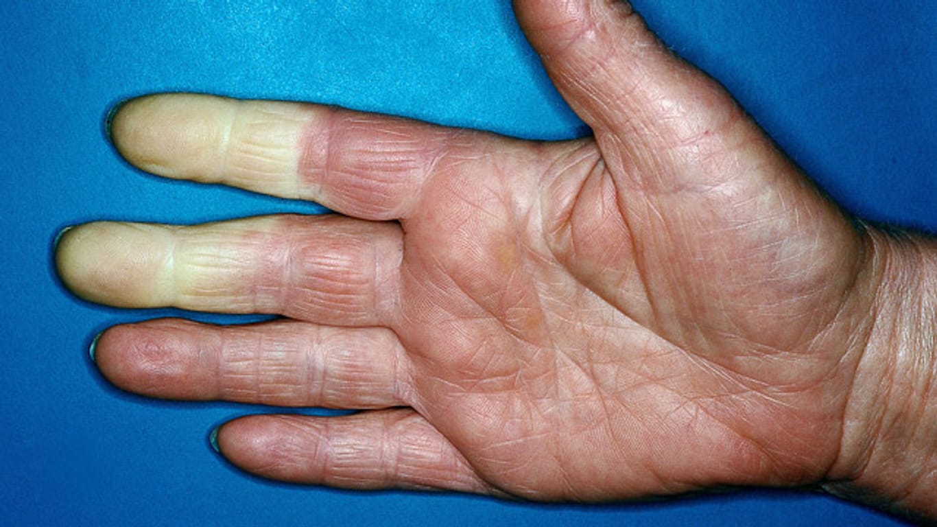 Beim Raynaud-Syndrom werden die Finger plötzlich weiß, kalt und taub.
