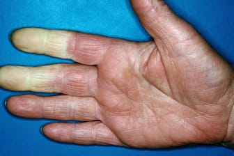 Beim Raynaud-Syndrom werden die Finger plötzlich weiß, kalt und taub.