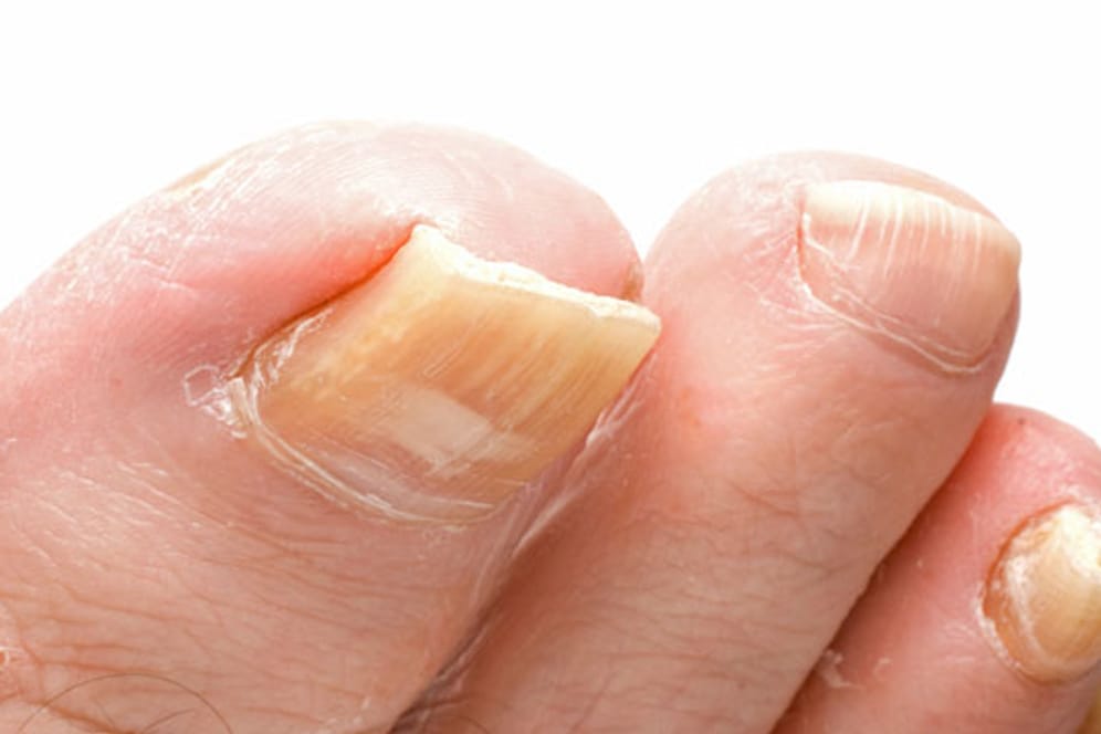 Ein verdickter und verfärbter Fußnagel weist auf Nagelpilz hin.