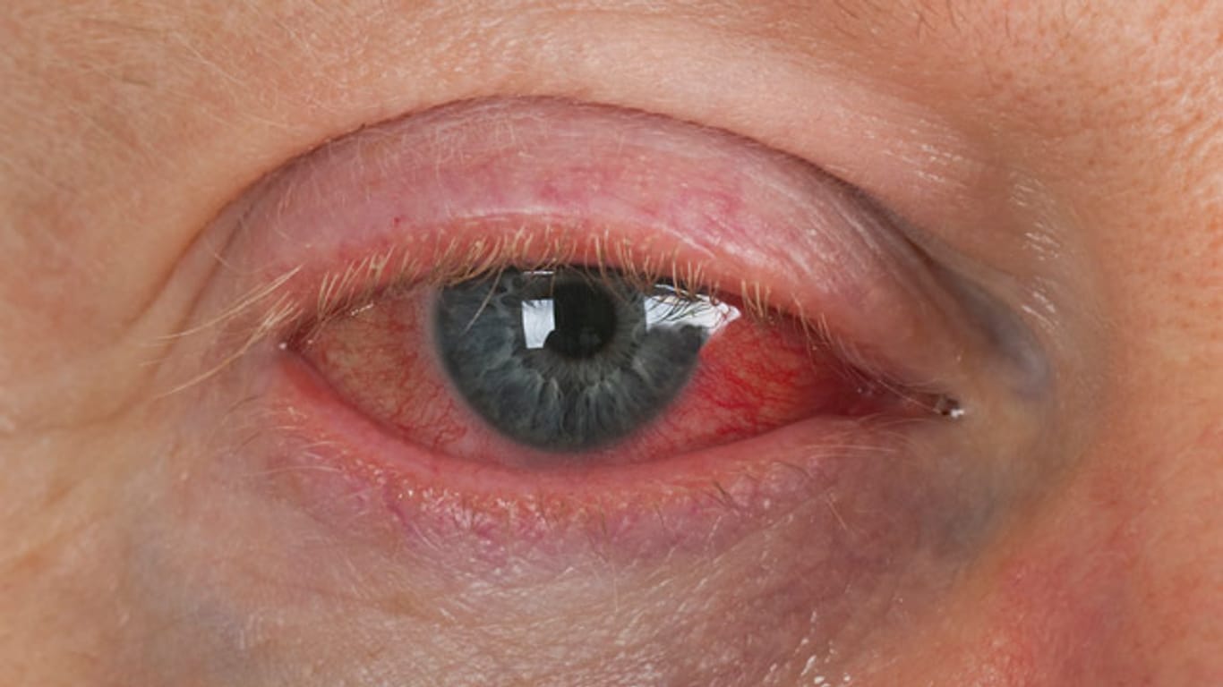 Typische Symptome der Augengrippe sind tränende, geschwollene und schmerzende Augen.