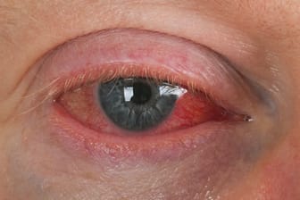 Typische Symptome der Augengrippe sind tränende, geschwollene und schmerzende Augen.