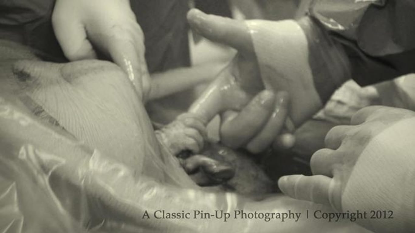 Ein magischer Moment: Nevaeh ist noch nicht geboren und ergreift schon den Finger des Arztes, der sie gleich per Kaiserschnitt auf die Welt bringen wird.