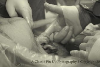 Ein magischer Moment: Nevaeh ist noch nicht geboren und ergreift schon den Finger des Arztes, der sie gleich per Kaiserschnitt auf die Welt bringen wird.