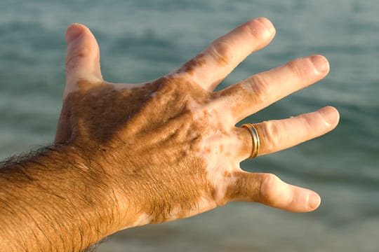 Vitiligo ist eine Hautkrankheit bei der sich weiße Flecken auf der Haut bilden.