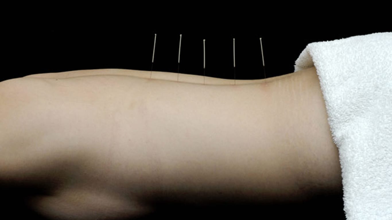 Akupunktur hilft bei Rheuma