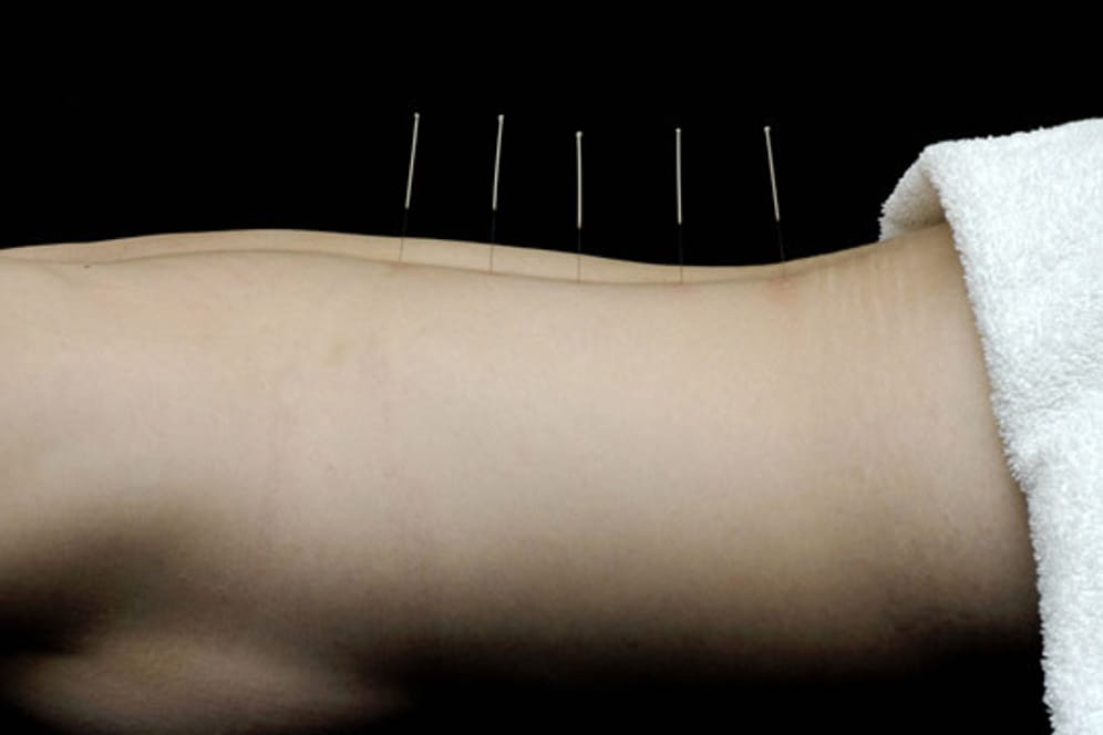 Akupunktur hilft bei Rheuma