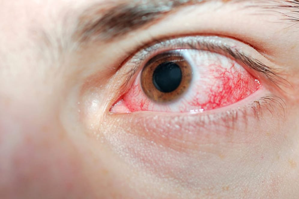 Platzt eine Ader im Auge, sollte auf jeden Fall ein Facharzt aufgesucht werden.