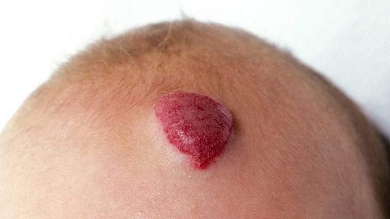 Blutschwamm auf der Stirn einen Babys