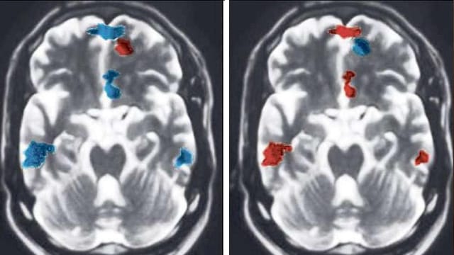 Partnerschaft: Gehirnscans zeigen Chancen.