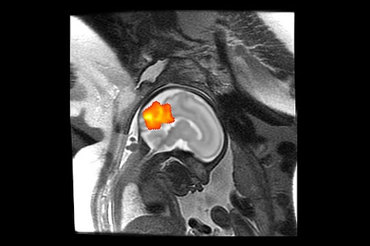 Gehirnentwicklung: Es sind die ersten Aufnahmen, die die Gehirnentwicklung eines Fötus dokumentieren.