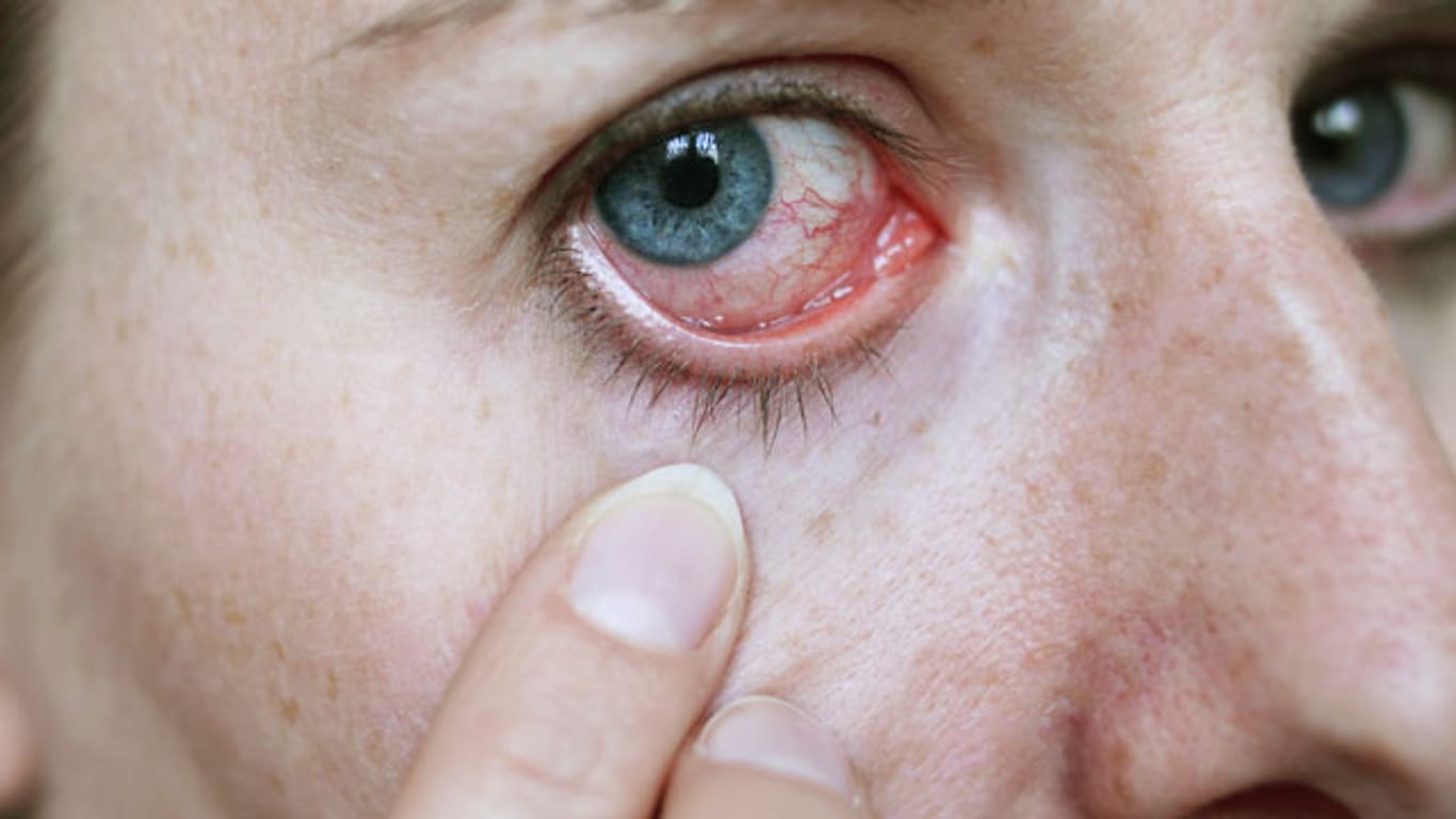 Veränderungen am äußeren Auge können auf einen Lidtumor hinweisen.