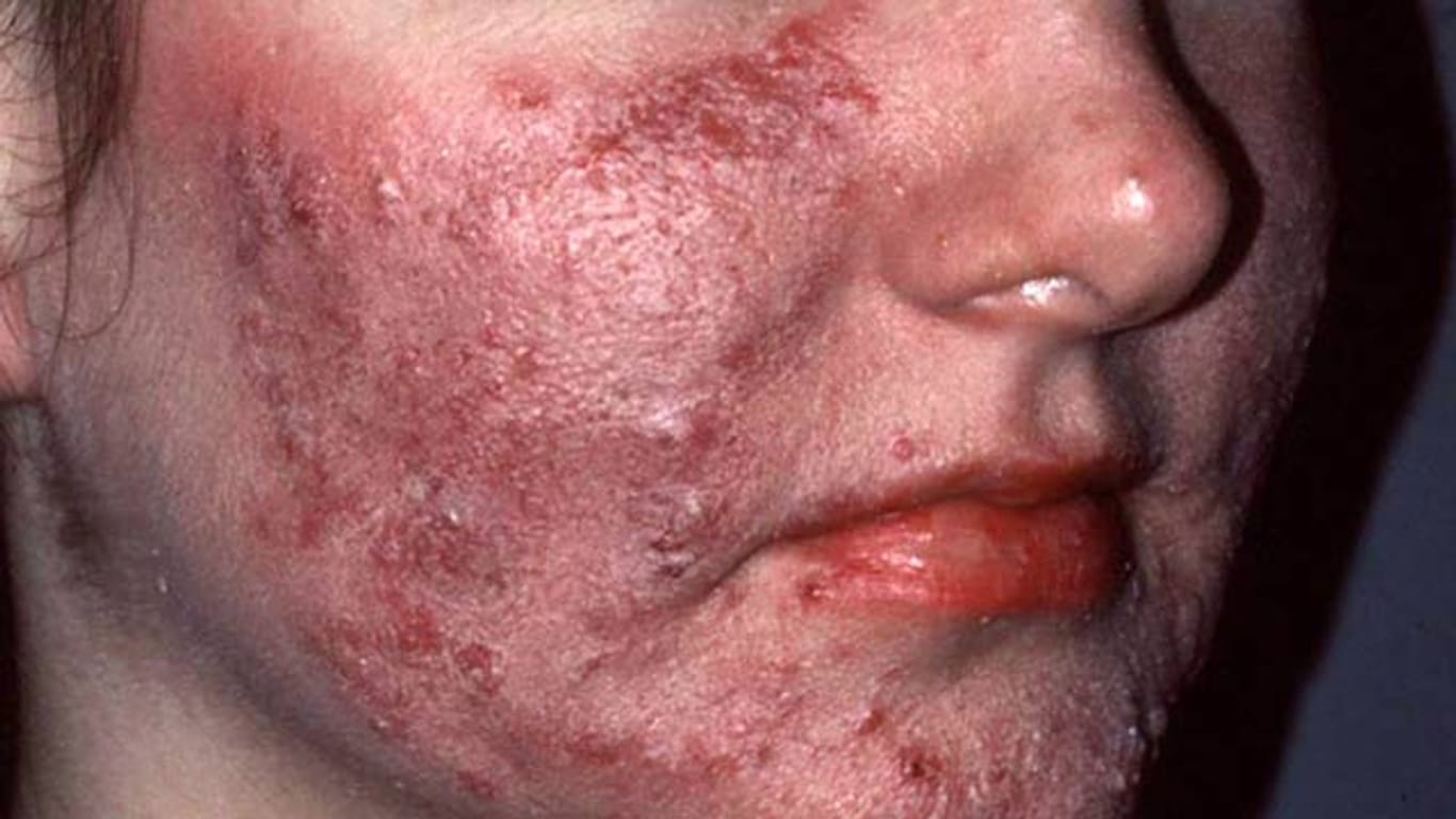 Rosacea kann sich bei akuten Krankheitsschüben über das gesamte Gesicht ausbreiten.