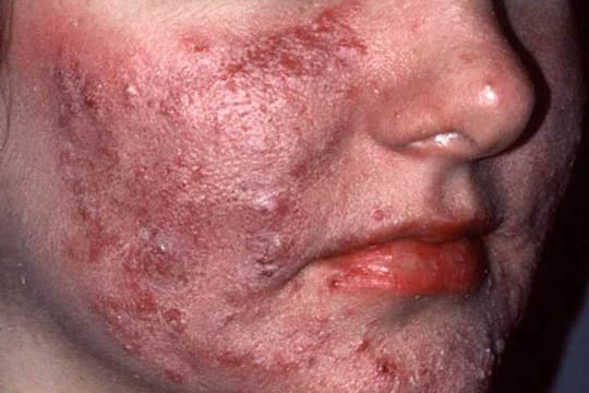 Rosacea kann sich bei akuten Krankheitsschüben über das gesamte Gesicht ausbreiten.