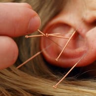 Akupunktur: Eine sanfte alternative Heilmethode gegen Allergien