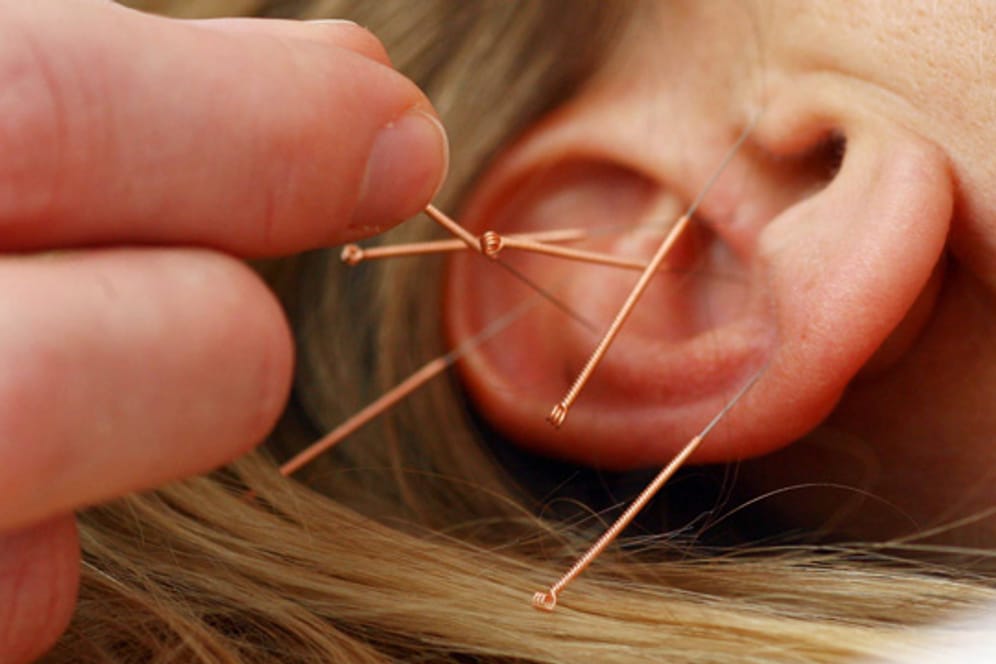 Akupunktur: Eine sanfte alternative Heilmethode gegen Allergien
