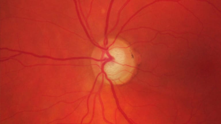Glaukom: Dieses digitale Foto zeigt, wie ein Glaukom den Sehnerv zerstört.