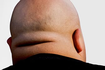 Der Stiernacken kommt nicht nur durchs Fitness-Studio. Auch beim Cushing-Syndrom wird der Hals-Nacken-Bereich dicker.