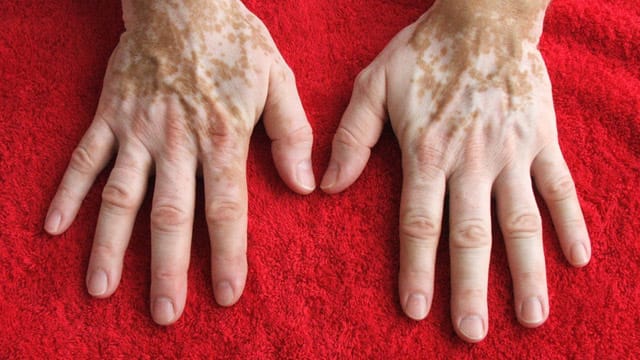 Hinter der Weißfleckenkrankheit Vitiligo verbirgt sich eine unheilbare Autoimmunkrankheit.