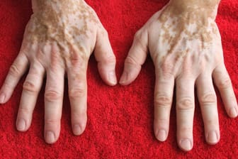 Hinter der Weißfleckenkrankheit Vitiligo verbirgt sich eine unheilbare Autoimmunkrankheit.