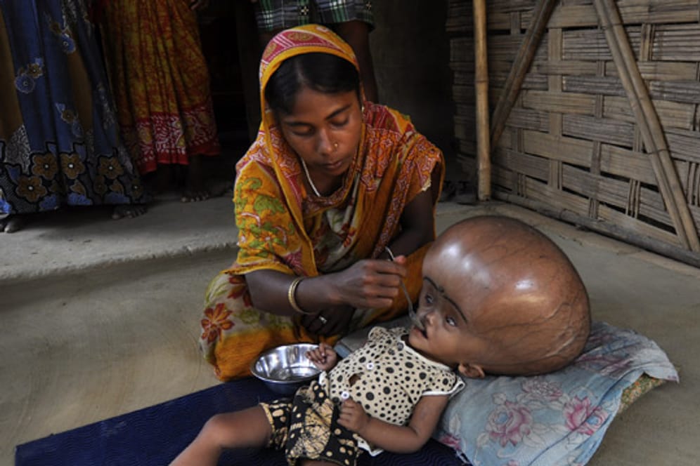Fatima Khatun (25) füttert ihre Tochter Roona, die an der Wasserkopf-Krankheit leidet.