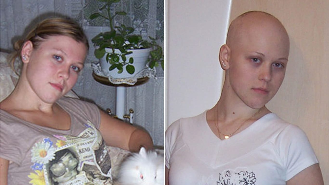 Ewing-Sarkom: Natalie heute mit 24 Jahren und als 17-Jährige nach ihrem ersten Chemo-Block.