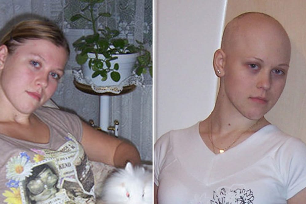 Ewing-Sarkom: Natalie heute mit 24 Jahren und als 17-Jährige nach ihrem ersten Chemo-Block.