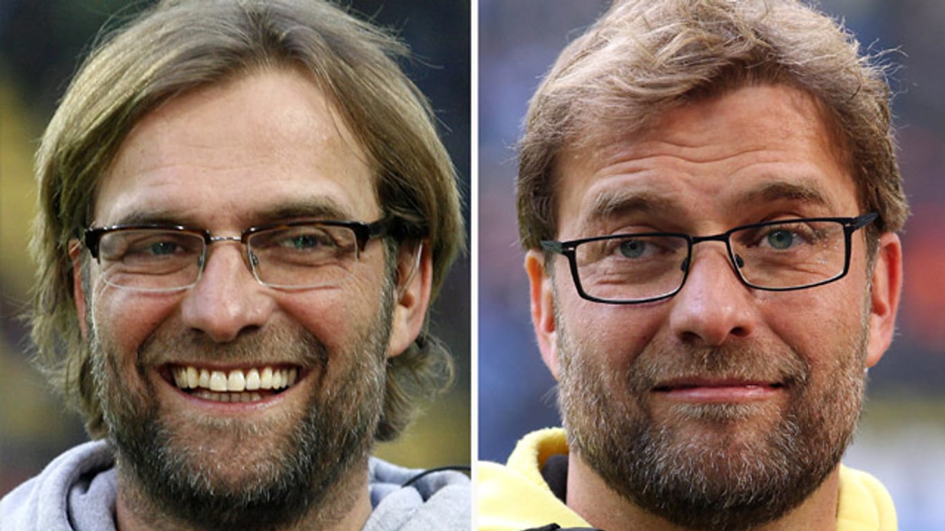 Jürgen Klopp vor und nach seiner Haartransplantation