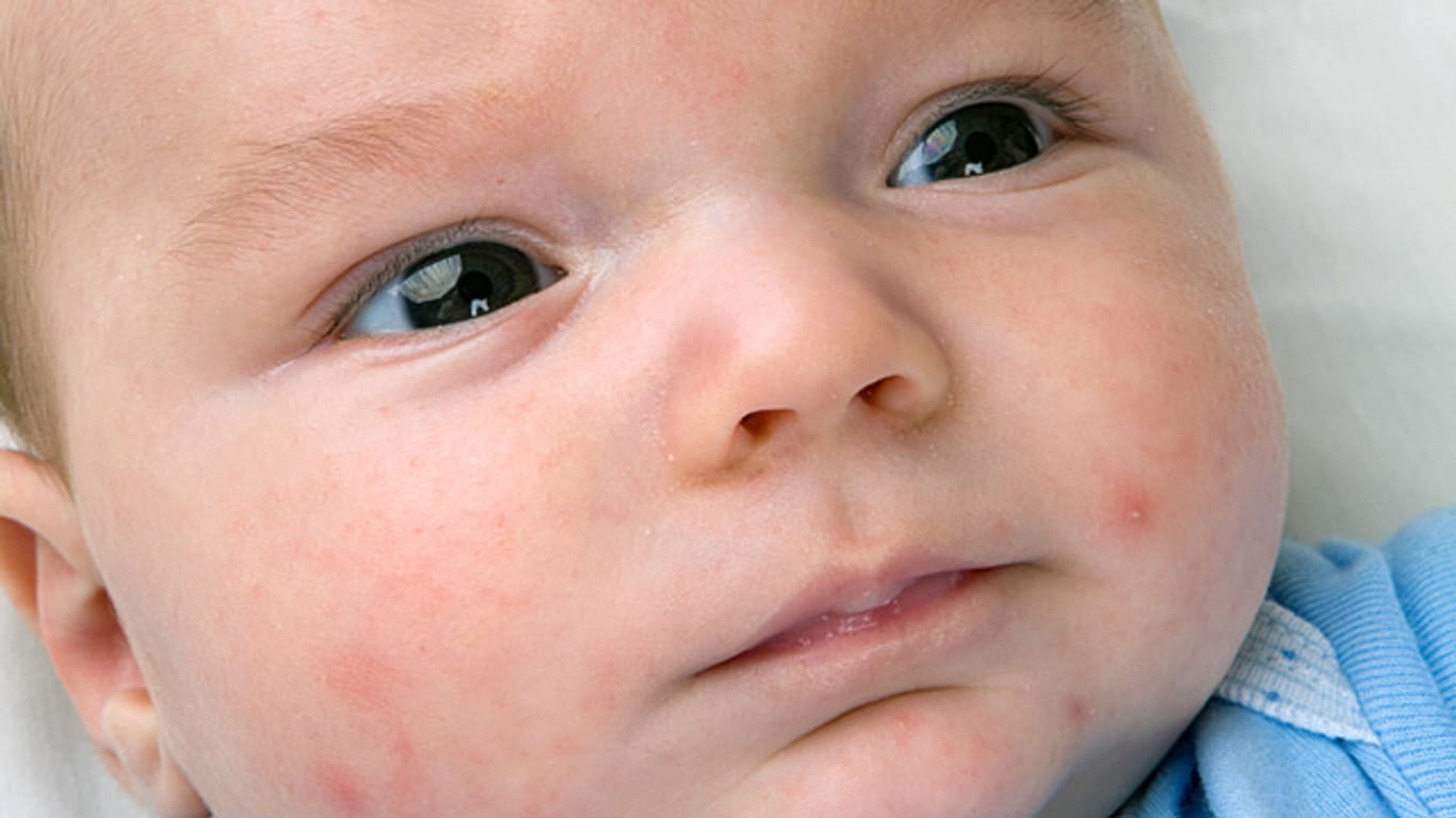 Von wegen zart wie ein Babypopo: Viele Babys haben mit Akne und anderen Hautproblemen zu kämpfen.