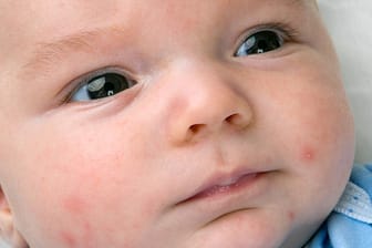 Von wegen zart wie ein Babypopo: Viele Babys haben mit Akne und anderen Hautproblemen zu kämpfen.