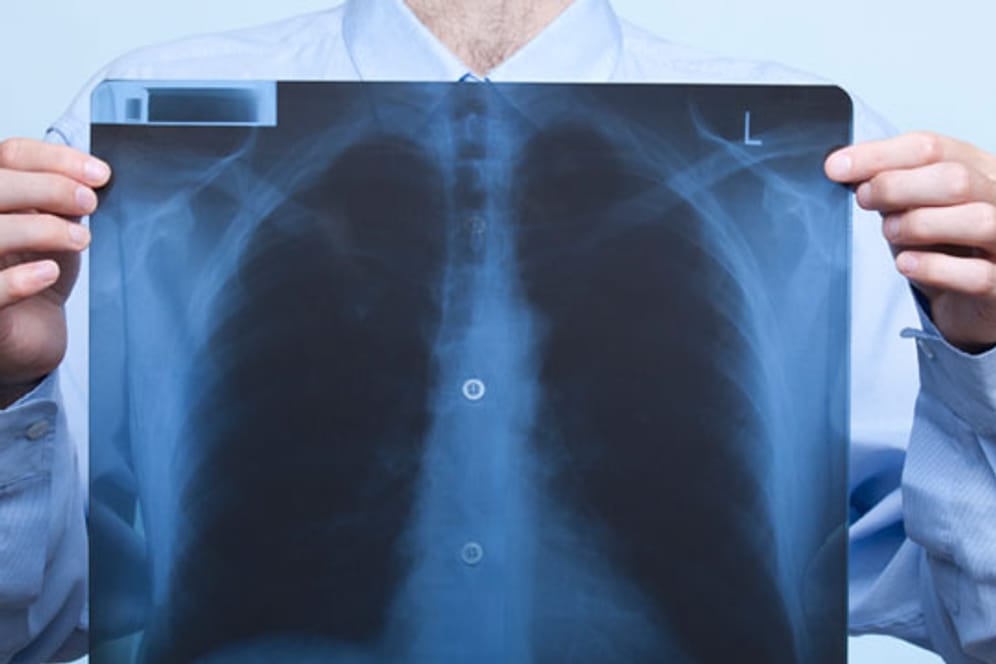 Lunge: Bei einem Lungenkollaps liefern Röntgenbilder der Lunge eine eindeutige Diagnose.