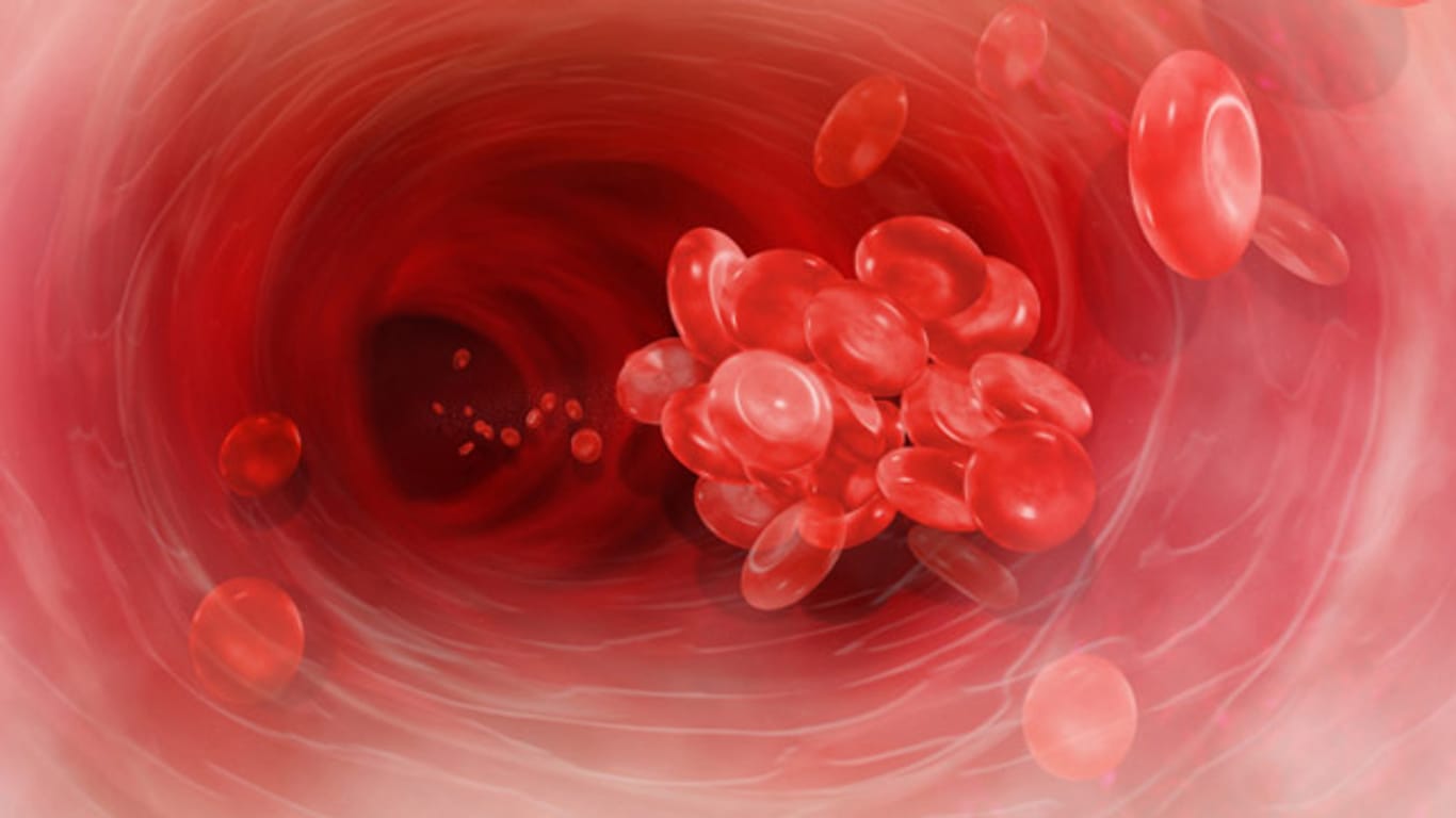 Blutgerinnsel in der Vene lösen eine Thrombose aus.