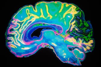 Alzheimer: Neues Gehirnscan-Verfahren gibt Hoffnung bei der Früherkennung.