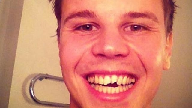 Mitch Langerak nimmt die abgebrochenen Schneidezähne mit Humor.