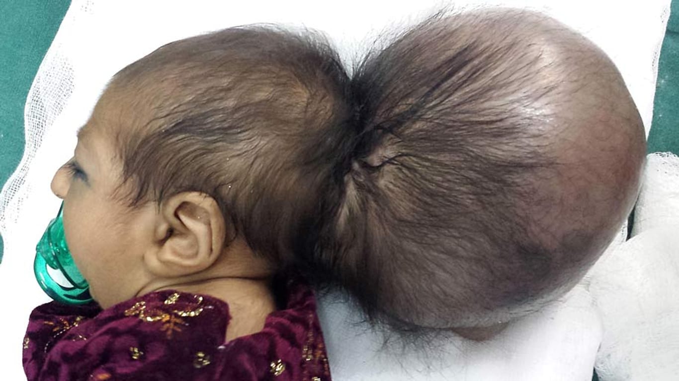 Asree G., Baby mit zwei Köpfen aus Afghanistan