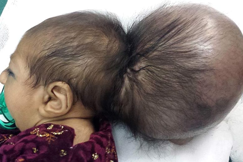 Asree G., Baby mit zwei Köpfen aus Afghanistan