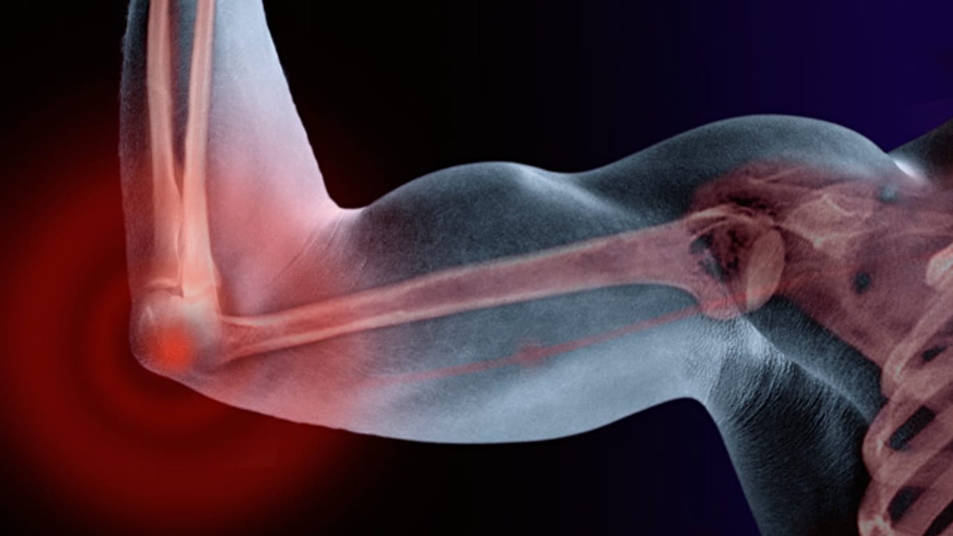 Unklare Muskel- und Knochenschmerzen: Oft ist Vitamin-D-Mangel schuld.