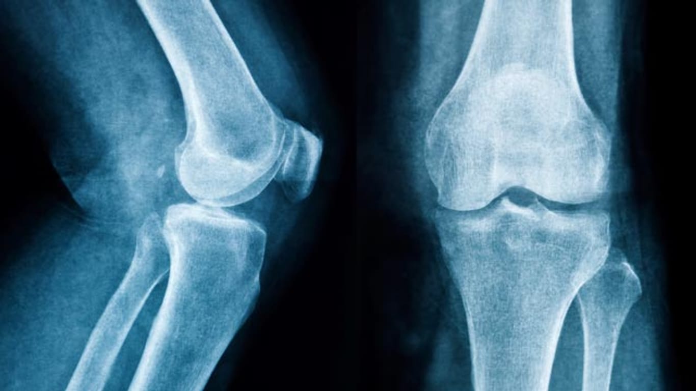 Knie: Zig mal geröntgt, seziert und analysiert und doch übersehen: Im menschlichen Knie wurde ein neues Band gefunden.
