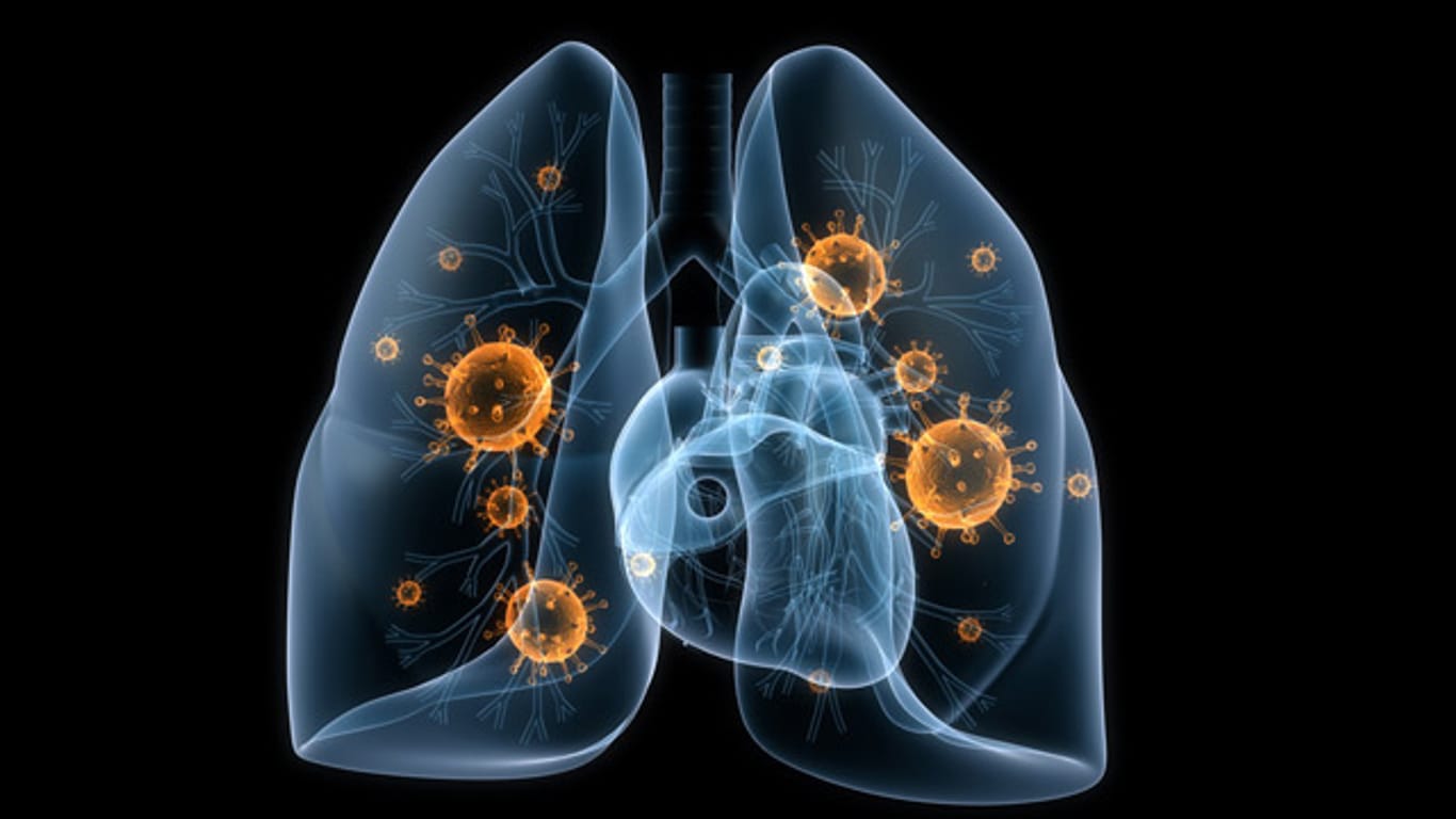 Lipidpneumonie: Fetthaltige Cremes oder Sprays können eine Lungenentzündung verursachen.