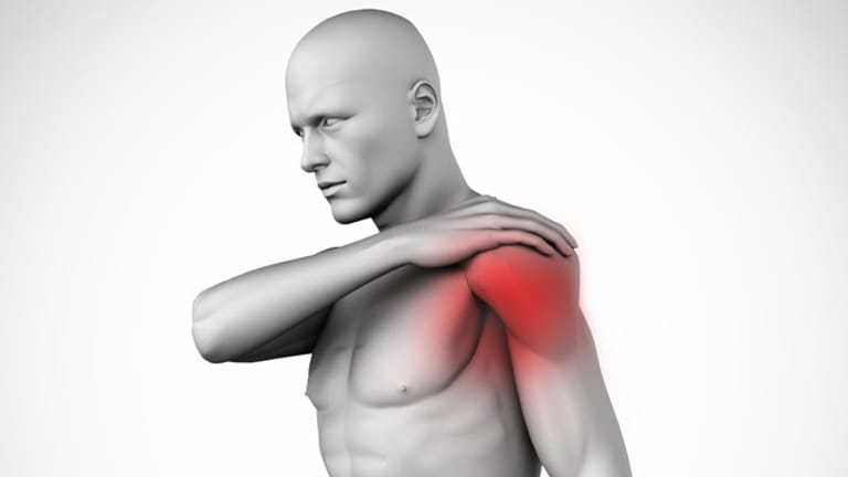 Polymyalgia rheumatica löst anfangs oft Schulterschmerzen aus.