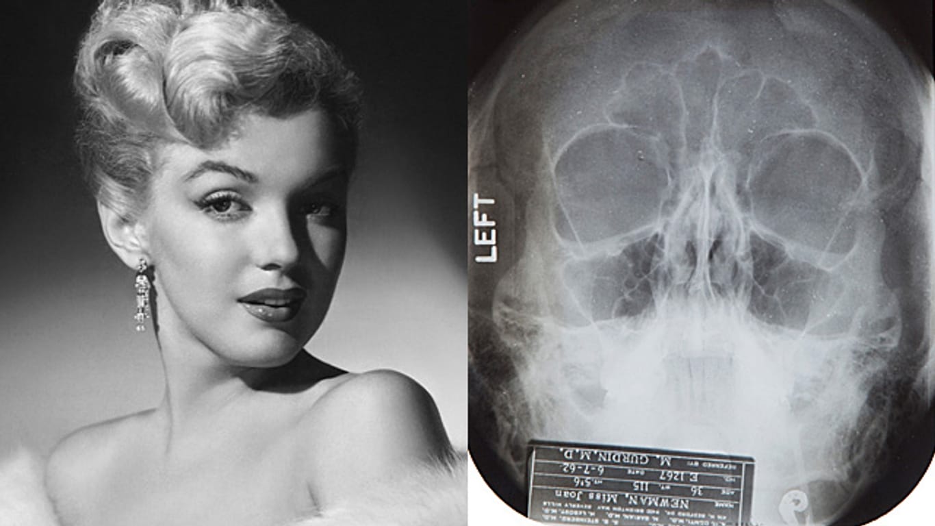 Röntgenbilder von Marilyn Monroes Schädel versteigert.