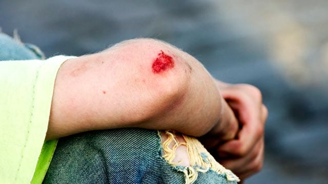 Hinter mancher Schramme steckt eine Misshandlung, Ärzte sind darauf jedoch nicht immer vorbereitet. Hinter mancher Schramme steckt eine Misshandlung, Ärzte sind darauf jedoch nicht immer vorbereitet.