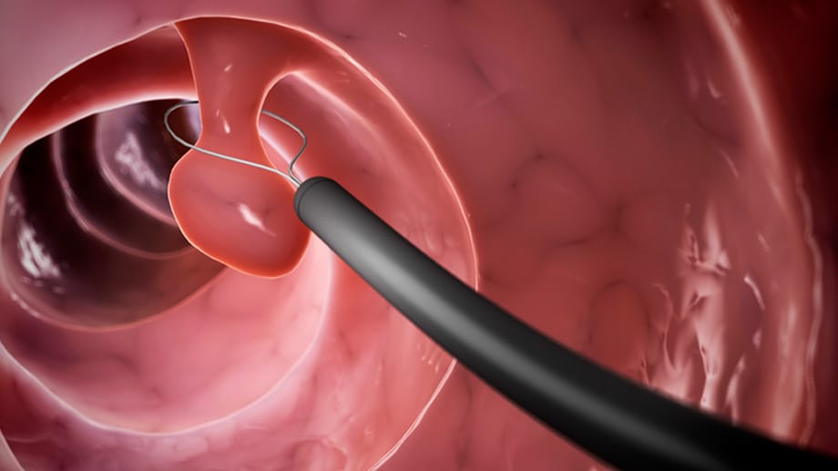 Darmpolypen können bei einer Endoskopie einfach entfernt werden.