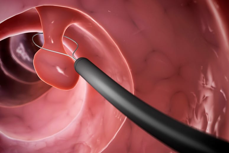 Darmpolypen können bei einer Endoskopie einfach entfernt werden.
