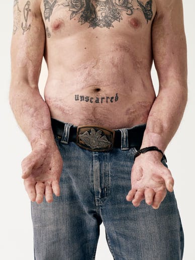 "Unscarred" (zu Deutsch: ohne Narben) prangt auf dem Bauch von Private Karl Hinett, der 2005 mit 18 Jahren bei einem Einsatz im Irak mit Benzin übergossen und angezündet wurde.