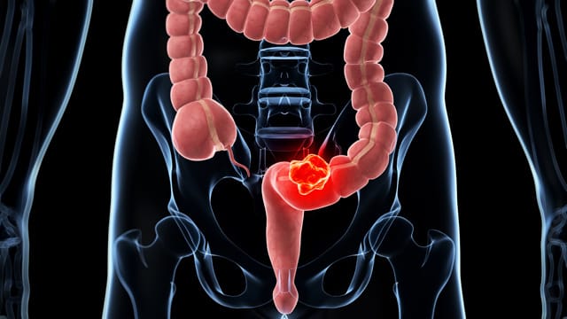 Darmkrebs: Jedes Jahr erkranken in Deutschland etwa 57.000 Menschen neu an Darmkrebs.